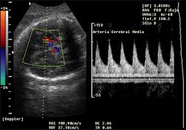 doppler obstetrico - Diego Hara